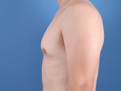 Gynecomastia Surgery Before & After Image