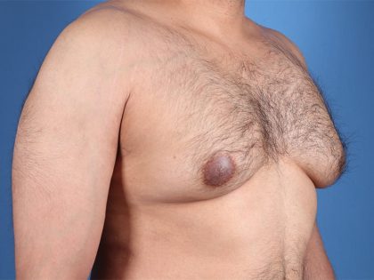 Gynecomastia Surgery Before & After Image