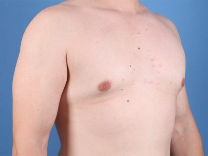 Gynecomastia Surgery Before & After Image