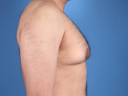 Gynecomastia Surgery Before & After Image