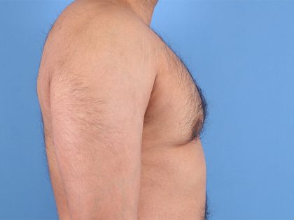 Gynecomastia Surgery Before & After Image