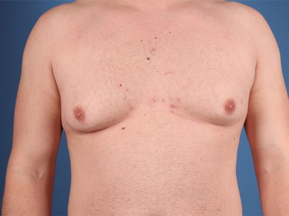 Gynecomastia Surgery Before & After Image