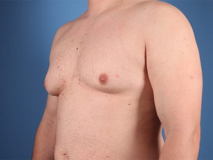 Gynecomastia Surgery Before & After Image