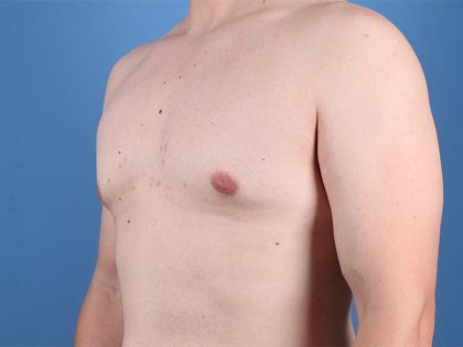 Gynecomastia Surgery Before & After Image