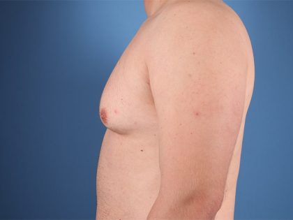 Gynecomastia Surgery Before & After Image