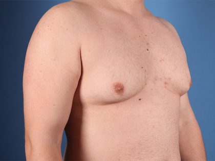 Gynecomastia Surgery Before & After Image