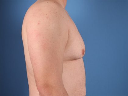 Gynecomastia Surgery Before & After Image