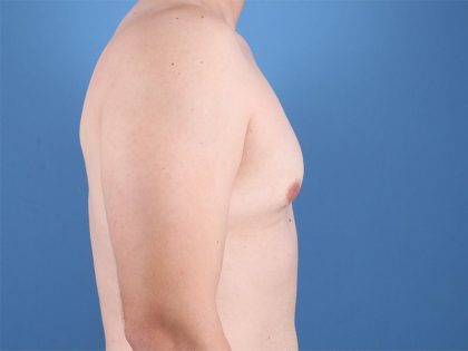 Gynecomastia Surgery Before & After Image