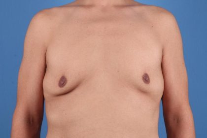 Gynecomastia Surgery Before & After Image