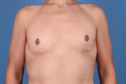 Gynecomastia Surgery Before & After Image