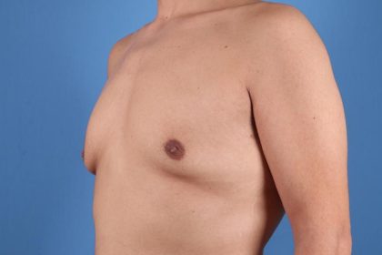 Gynecomastia Surgery Before & After Image