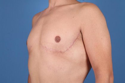 Gynecomastia Surgery Before & After Image