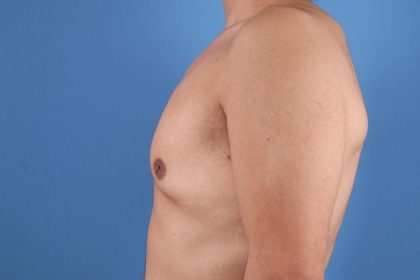 Gynecomastia Surgery Before & After Image