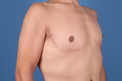 Gynecomastia Surgery Before & After Image