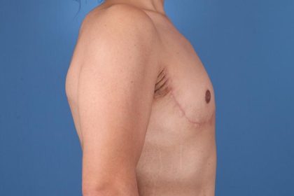 Gynecomastia Surgery Before & After Image