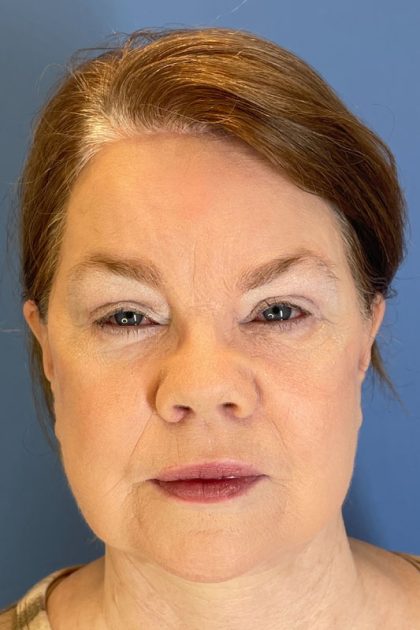 Brow Lift Before & After Image