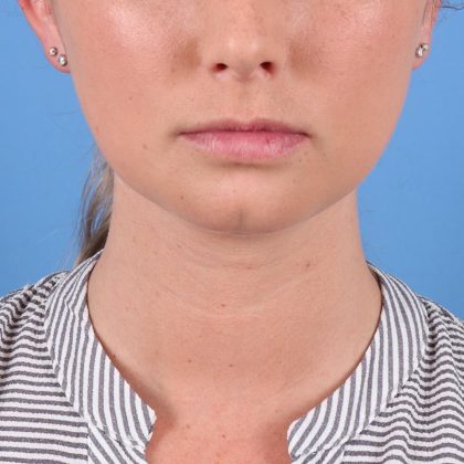 Chin Augmentation Before & After Image