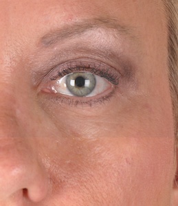 Eyelid Surgery Before & After Image