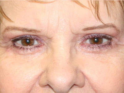 Eyelid Surgery Before & After Image