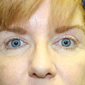 Eyelid Surgery Before & After Image