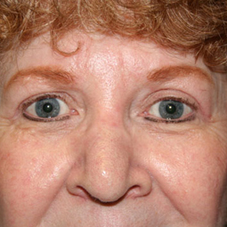 Eyelid Surgery Before & After Image