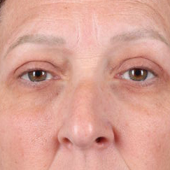 Eyelid Surgery Before & After Image