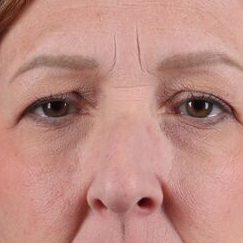 Eyelid Surgery Before & After Image