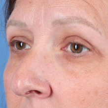 Eyelid Surgery Before & After Image