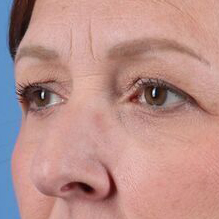 Eyelid Surgery Before & After Image