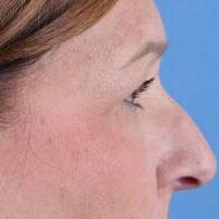 Eyelid Surgery Before & After Image