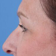 Eyelid Surgery Before & After Image