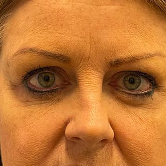 Eyelid Surgery Before & After Image