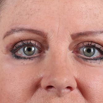 Eyelid Surgery Before & After Image