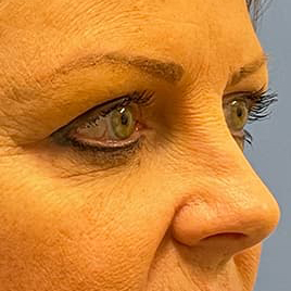 Eyelid Surgery Before & After Image