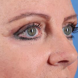 Eyelid Surgery Before & After Image