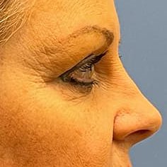 Eyelid Surgery Before & After Image