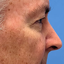 Eyelid Surgery Before & After Image