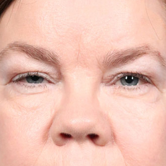 Eyelid Surgery Before & After Image