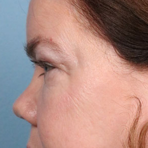 Eyelid Surgery Before & After Image