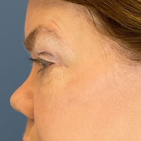 Eyelid Surgery Before & After Image