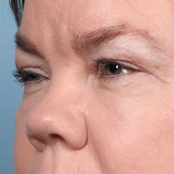 Eyelid Surgery Before & After Image