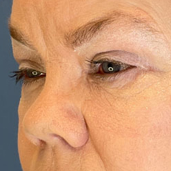 Eyelid Surgery Before & After Image