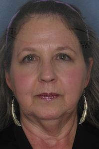 Face & Neck Lift Before & After Image