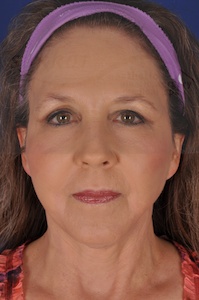 Face & Neck Lift Before & After Image