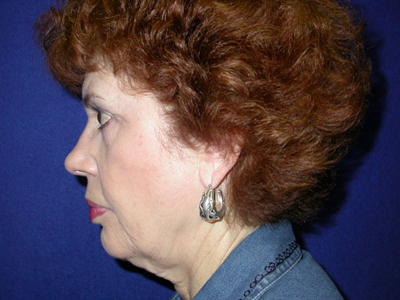 Face & Neck Lift Before & After Image