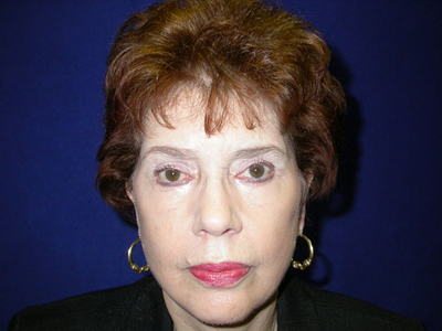 Face & Neck Lift Before & After Image