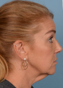 Face & Neck Lift Before & After Image