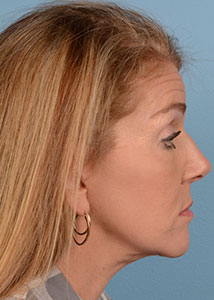 Face & Neck Lift Before & After Image