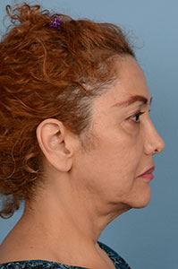 Face & Neck Lift Before & After Image