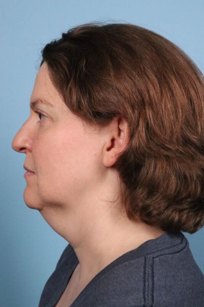 Face & Neck Lift Before & After Image